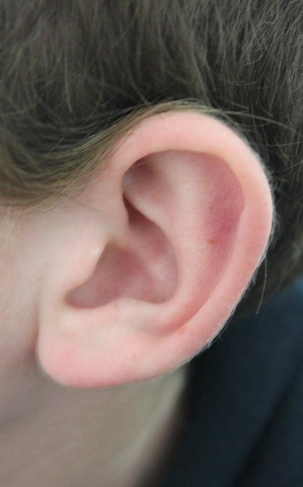Earring In Right Ear
 Pain behind ears when wearing glasses Doctor answers