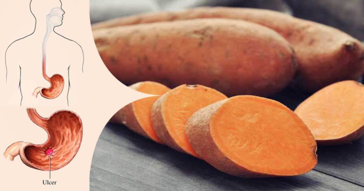 Sweet Potato Diabetes
 Treat Diabetes Stomach Ulcer and Heart Health with Sweet