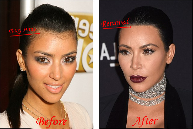 Baby Hair Removal
 Kim Kardashian Laser Hair Removal Before And After