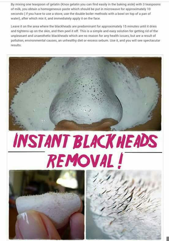 Best Face Mask For Blackhead Removal DIY
 Blackhead removal Home Body