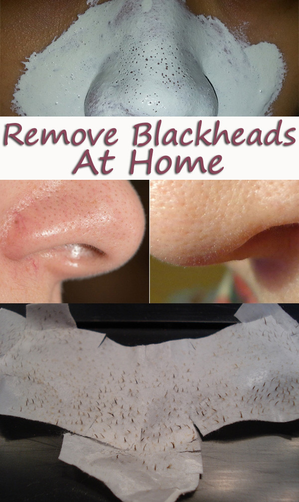 Best Face Mask For Blackhead Removal DIY
 Homemade Blackheads Remover Tutorials and Ideas Hative