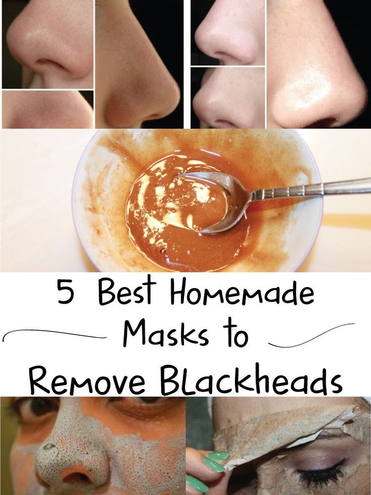 Best Face Mask For Blackhead Removal DIY
 5 Best Homemade Masks to Remove Blackheads