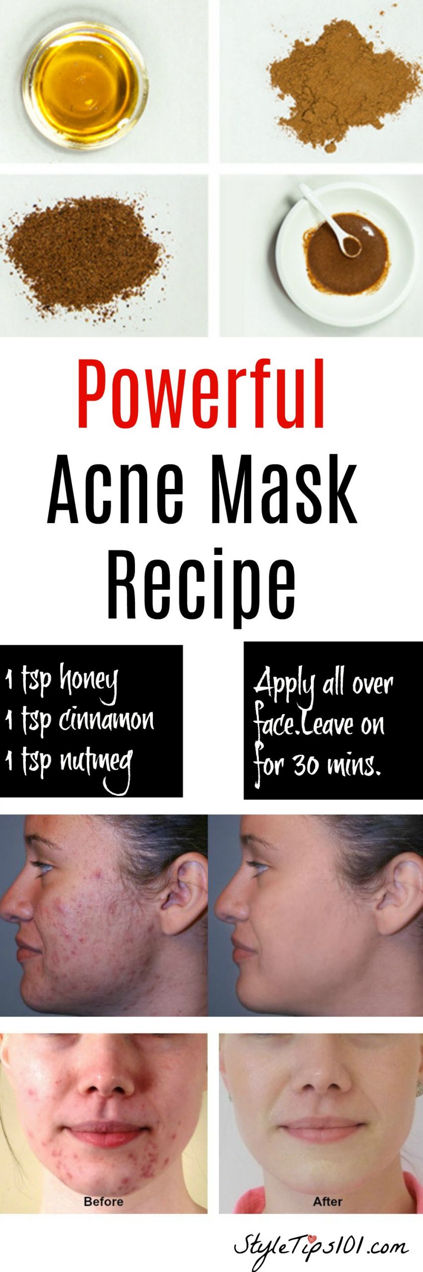 DIY Face Mask For Acne
 Homemade Natural Acne Mask