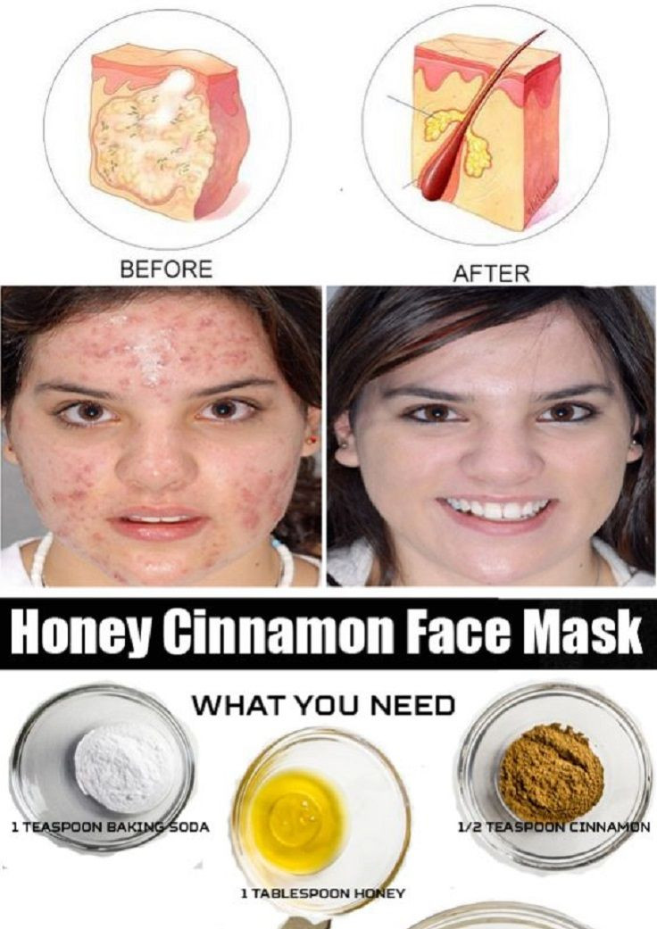 DIY Facial Mask For Acne Scars
 Honey and Cinnamon Face Mask for Cystic Acne 11 Anti