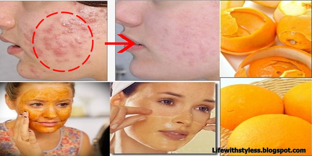 DIY Facial Mask For Acne Scars
 Homemade Orange Peel Face Mask For Pimples And Acne Scars