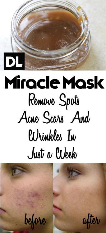 DIY Facial Mask For Acne Scars
 Homemade Face Mask to Get Rid of Spots Acne Scars and