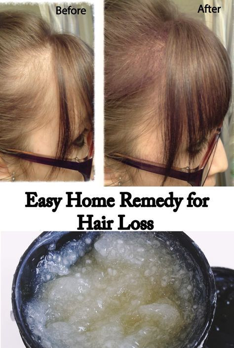 DIY Hair Loss Treatments
 Hair loss is affecting more and more people each year and