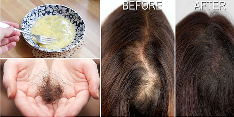 DIY Hair Loss Treatments
 Best Homemade Treatments For Hair Loss in Women