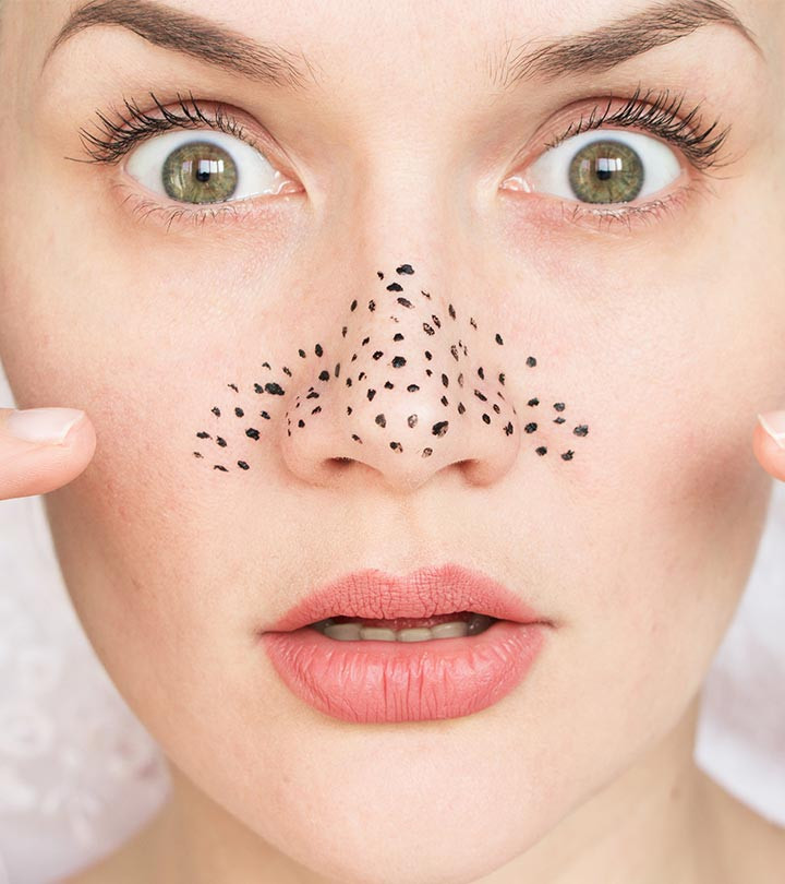 DIY Pimple Mask
 10 Best DIY Blackhead Removal Face Masks
