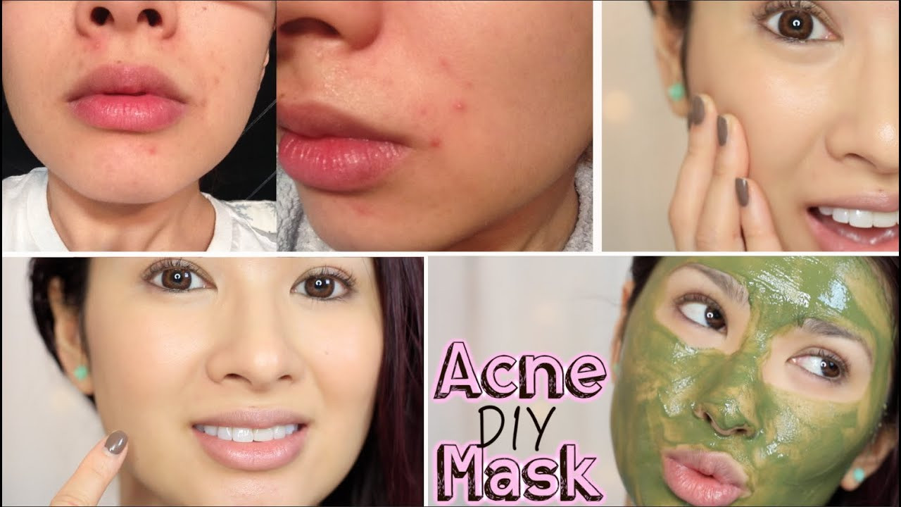 DIY Pimple Mask
 DIY Acne Mask