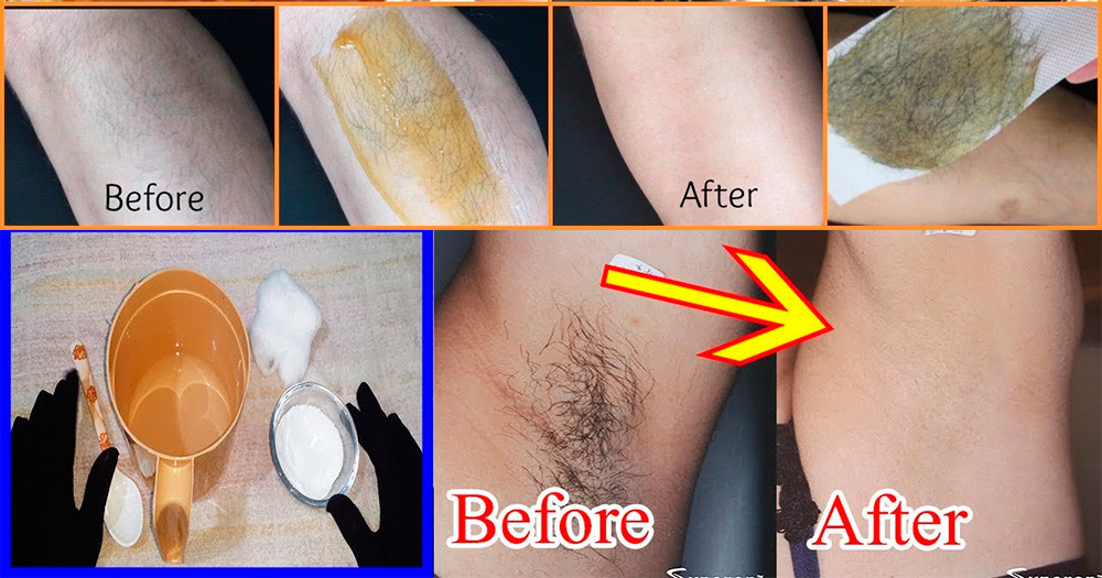 DIY Pubic Hair Removal
 Homemade Sugar Wax & Cream for Permanent Hair Removal