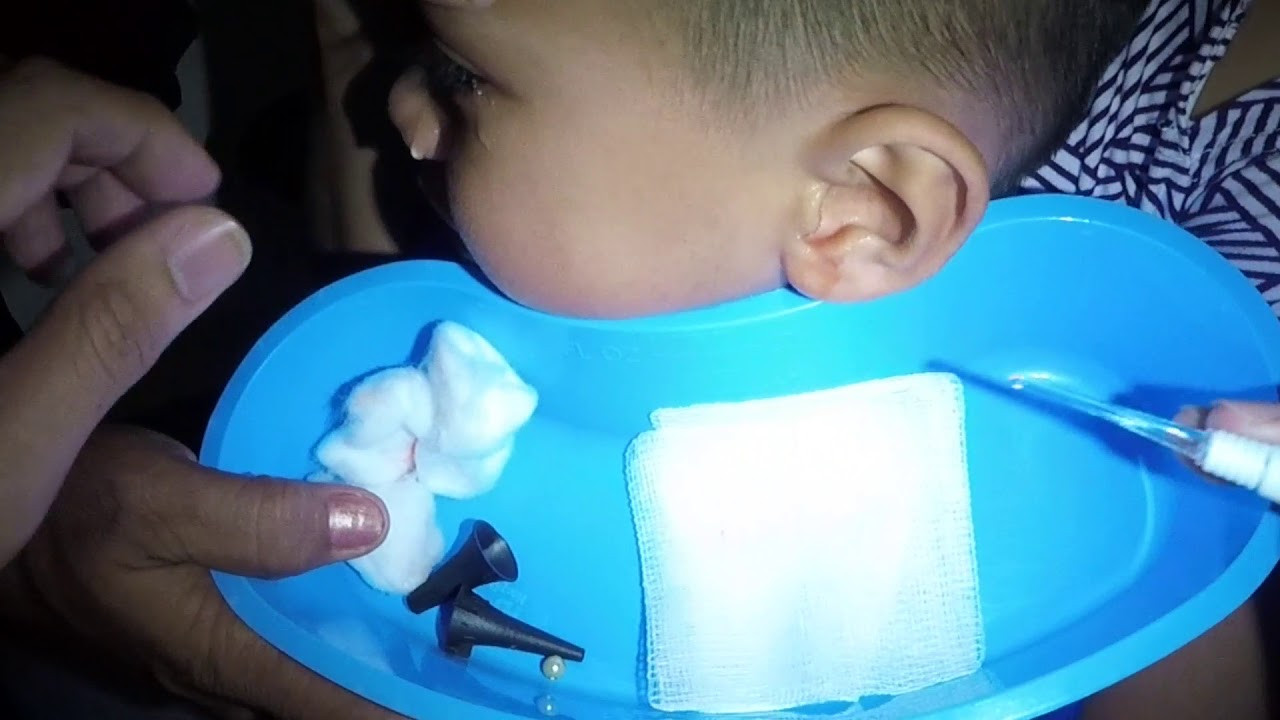 Earring Back Stuck In Earlobe
 Removal of Foreign Body Bead Stuck in Child s Ear