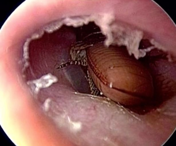 Earring Back Stuck In Earlobe
 Man 60 left with cockroach stuck in his ear canal for