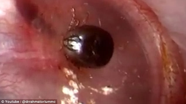 Earring Back Stuck In Earlobe
 Video of tick stuck in a patient’s ear