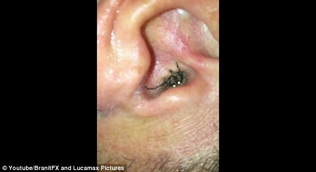 Earring Back Stuck In Earlobe
 Man finds a huge SPIDER hiding inside his ear