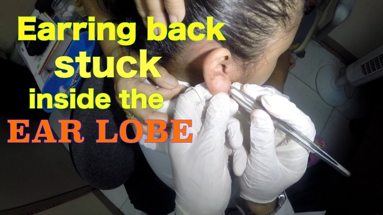 Earring Back Stuck In Earlobe
 Earring back stuck inside the earlobe