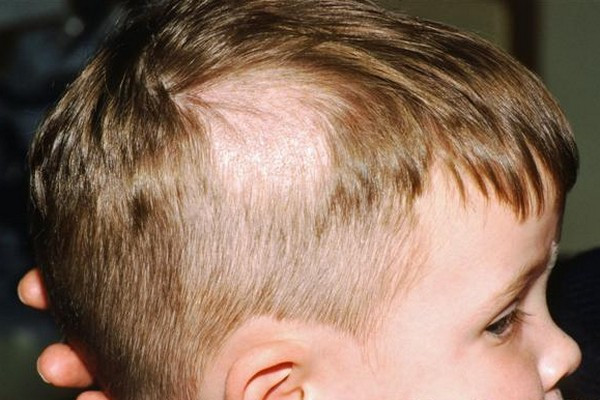 Hair Loss In Children
 Is Your Child Losing Hair You Might Check For These