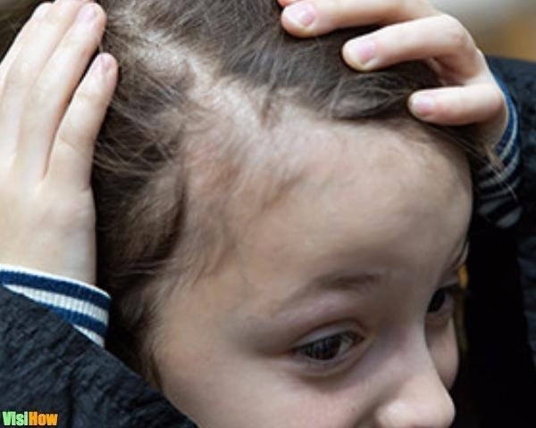 Hair Loss In Children
 Stop Childhood Hair Loss Due to Tinea Capitis vs Alopecia