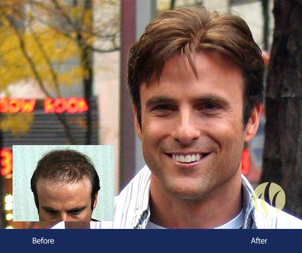 Mens Haircuts Minneapolis
 Men s Hair Replacement Minneapolis