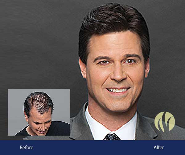 Mens Haircuts Minneapolis
 Men s Hair Replacement Minneapolis