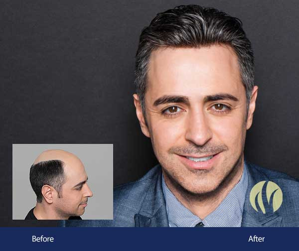 Mens Haircuts Minneapolis
 Men s Hair Replacement Minneapolis