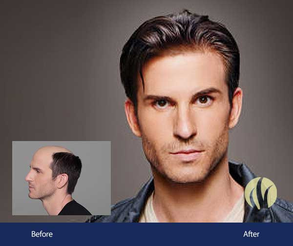 Mens Haircuts Minneapolis
 Men s Hair Replacement Minneapolis