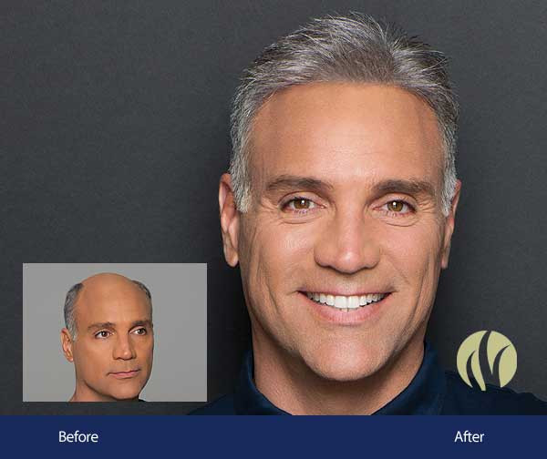 Mens Haircuts Minneapolis
 Men s Hair Replacement Minneapolis