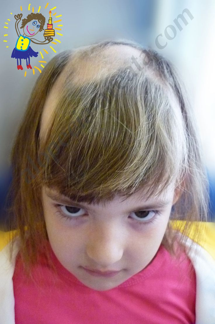 Sudden Hair Loss In Children
 39 best Women Hair Loss Alopecia Areata Alopecia Totalis