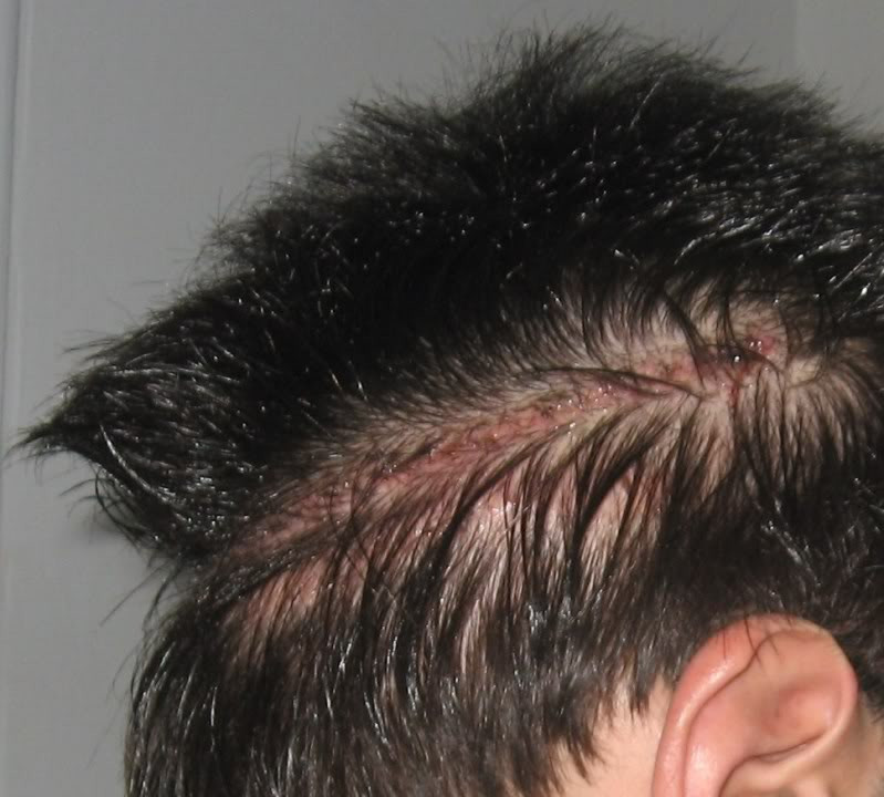 Sudden Hair Loss In Children
 Download free software Hair Loss Sudden Bald Patch Head