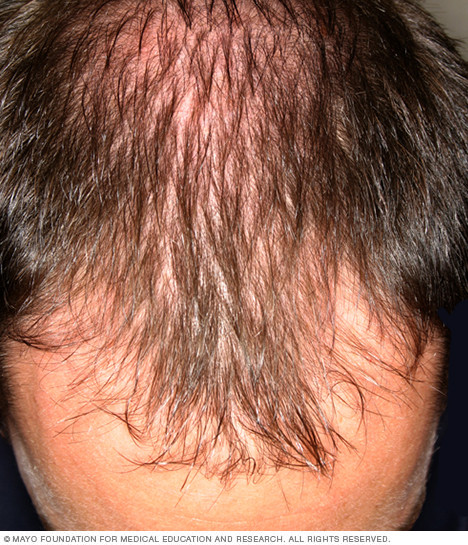 Sudden Hair Loss In Children
 Hair loss Disease Reference Guide Drugs
