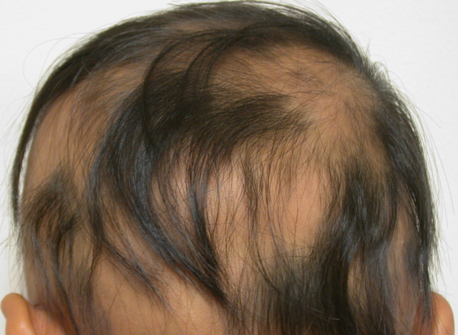 Sudden Hair Loss In Children
 Patchy Hair Loss Child