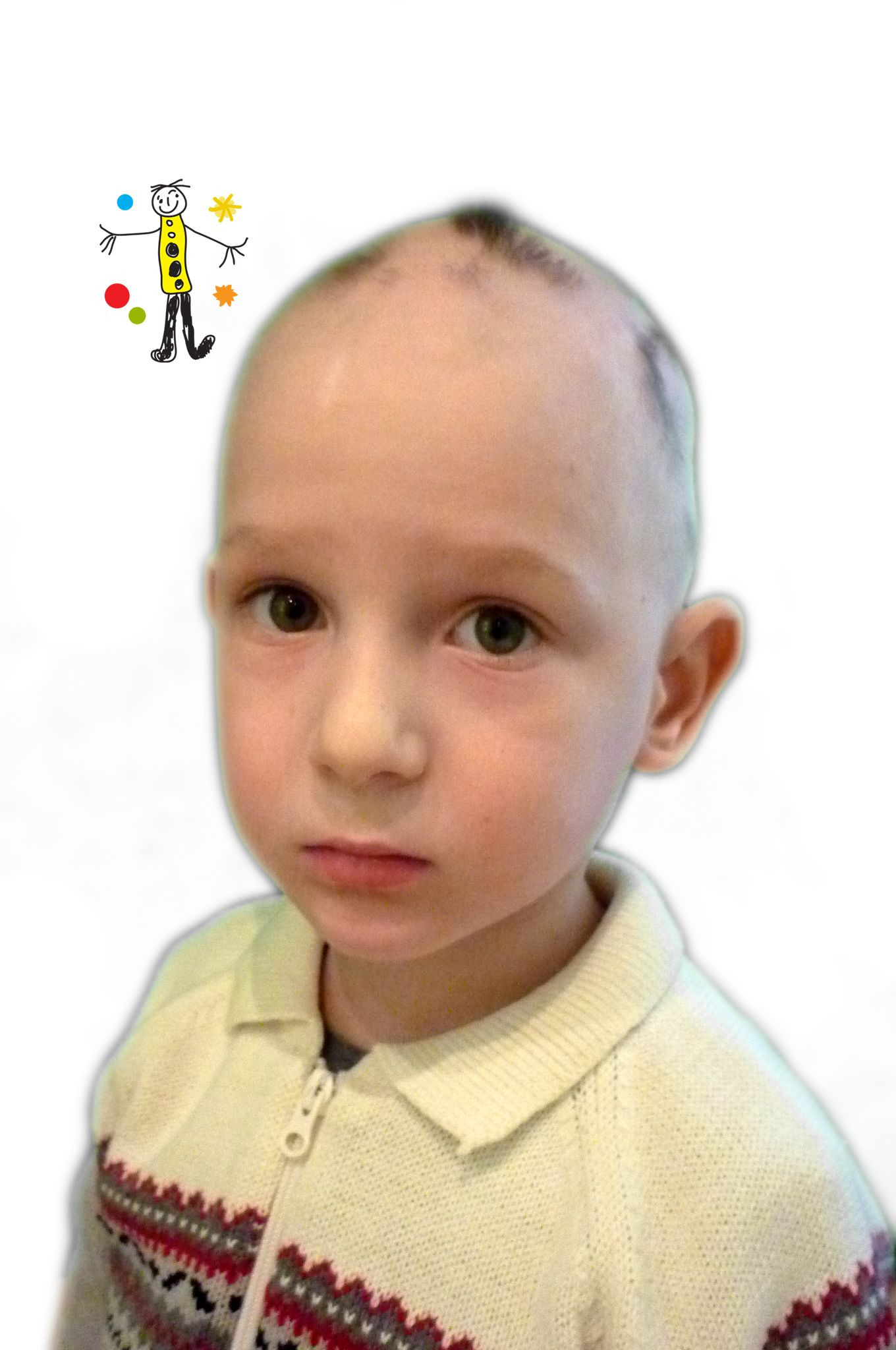 Sudden Hair Loss In Children
 Alopecia universalis in children I m 5 And this is my