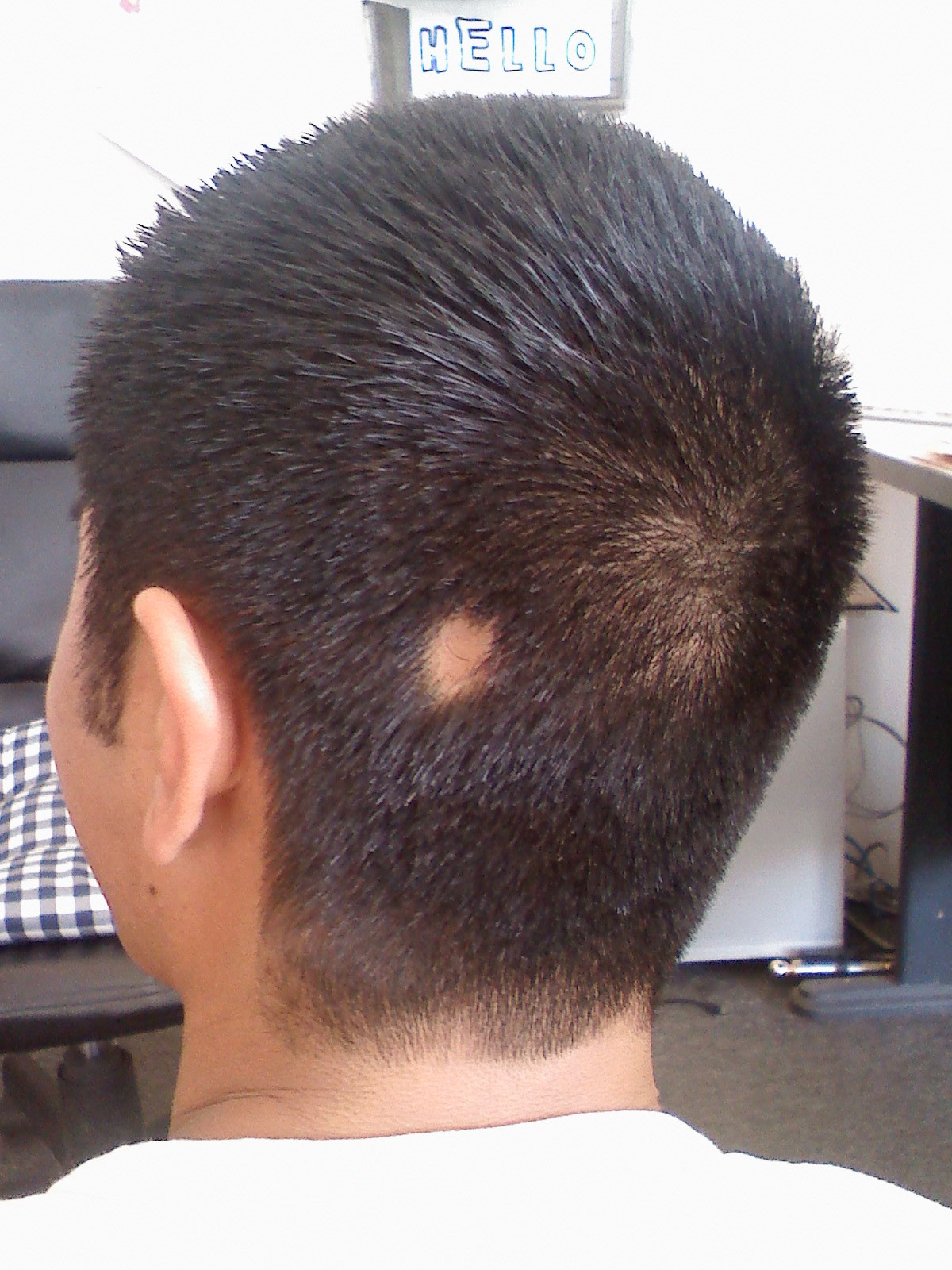 Sudden Hair Loss In Children
 Download free software Hair Loss Sudden Bald Patch Head