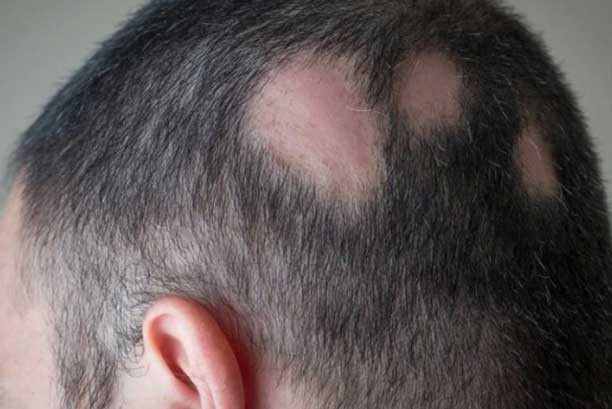Sudden Hair Loss In Children
 Find your hair fall solution by including these vitamins