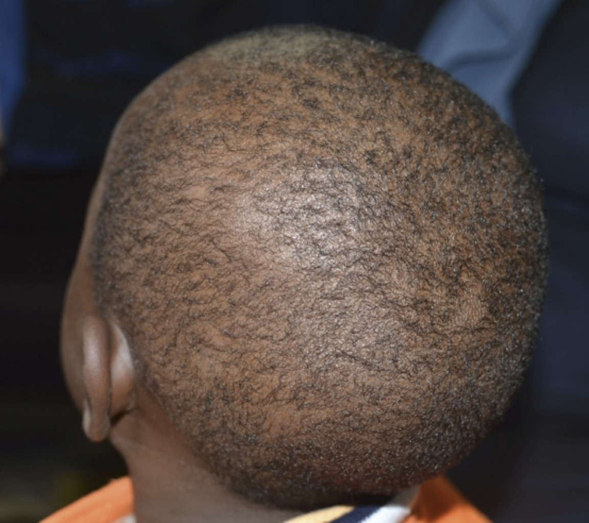 Sudden Hair Loss In Children
 Patchy Hair Loss In Child