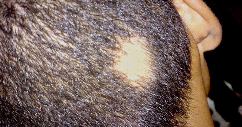 Sudden Hair Loss In Children
 What is alopecia areata Definition of alopecia areata