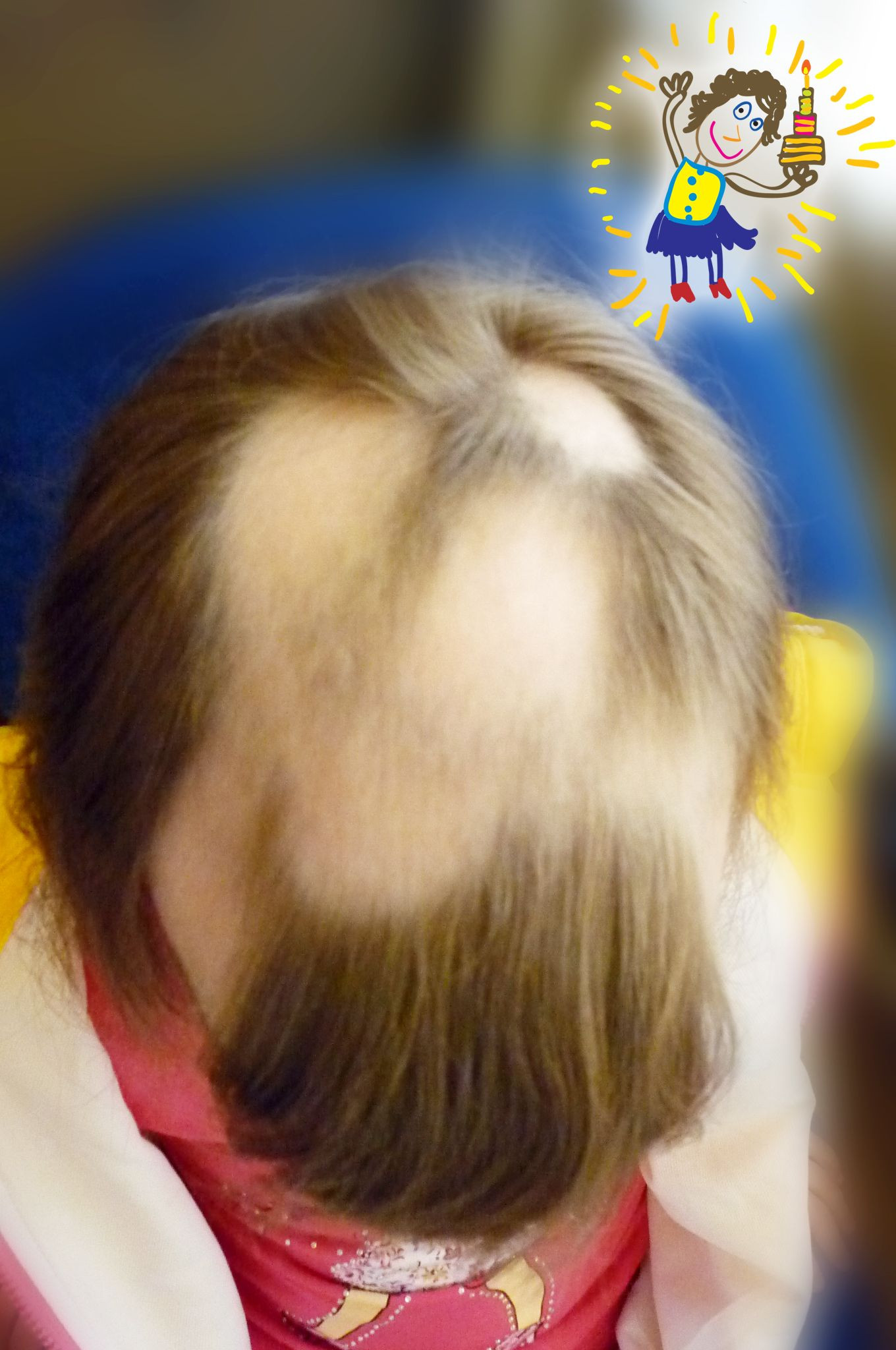 Sudden Hair Loss In Children
 Pin by ALOPECIA AREATA HOSPITAL HAIR LOSS TREATMENT on