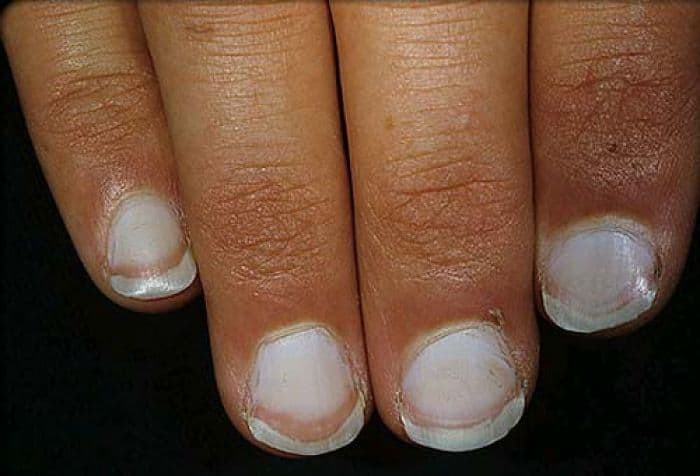 Toe Nail Colors Health
 Lunula of Nails What It Says About Your Health