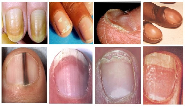 Toe Nail Colors Health
 21 Finger Abnormalities And What Important Things They