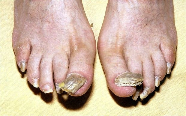 Toe Nail Colors Health
 Fingernail or toenail abnormalities can tell you a lot