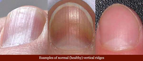 Toe Nail Colors Health
 8 Serious Health Warnings Your Fingernails May Be Sending