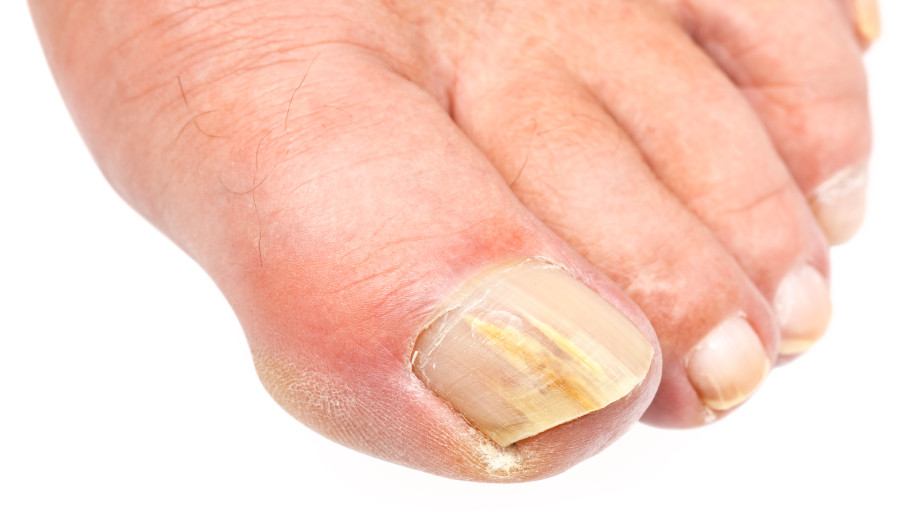Toe Nail Colors Health
 Why Are My Toenails Yellow Causes Treatment and