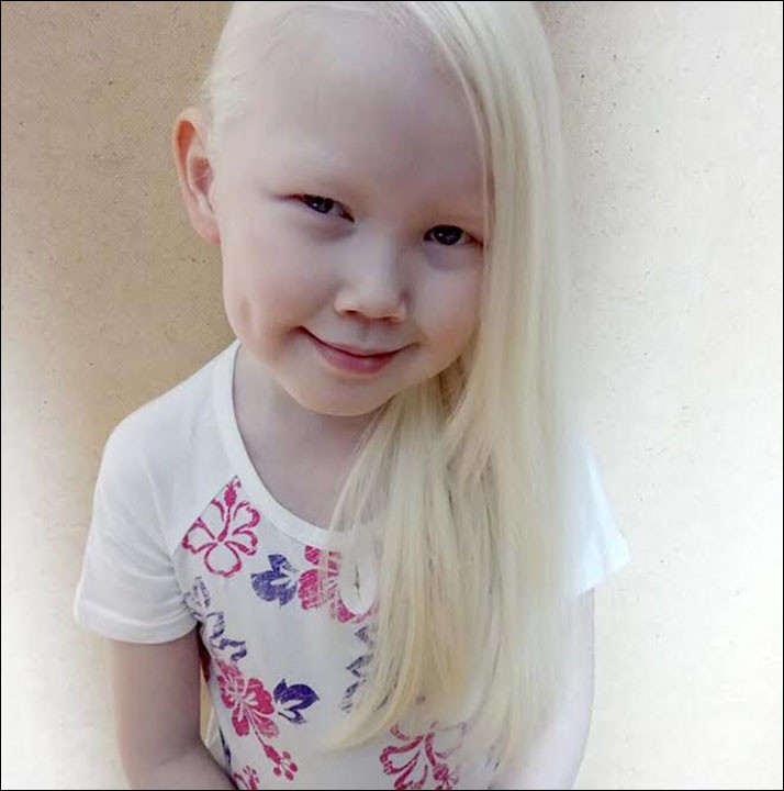 White Hair Kids
 Albino girl known as Snow White be es as internet